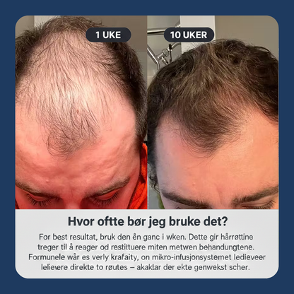 Hair Infusion Kit™ | Natural DHT Blocker