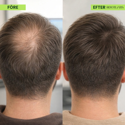 RØOT™ Hair Regrowth System
