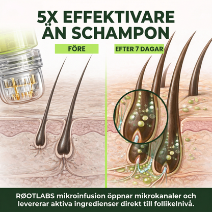 RØOT™ Hair Regrowth System